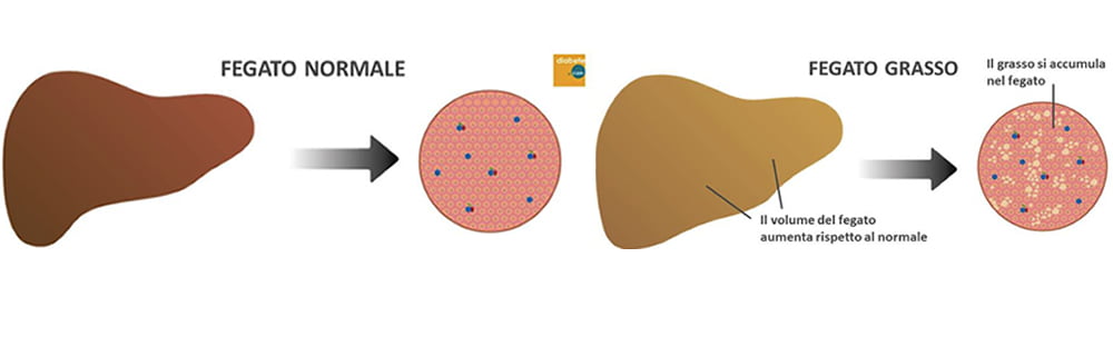 Fegato Grasso: Steatosi Epatica Non Alcolica (NAFLD) - Diabete.com