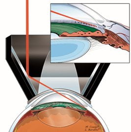 Il glaucoma si può operare: Argon Laser Trabeculoplastica Il glaucoma si può operare: Argon Laser Trabeculoplastica