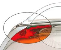 Il glaucoma si può operare: Fase chirurgica di un impianto drenante Il glaucoma si può operare: Fase chirurgica di un impianto drenante