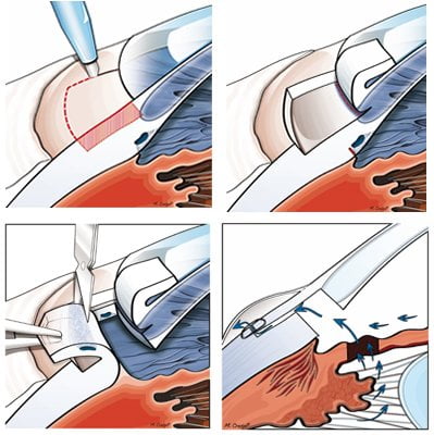 Il glaucoma si può operare: sequenza chirurgica della trabeculectomia nel glaucoma cronico Il glaucoma si può operare: sequenza chirurgica della trabeculectomia nel glaucoma cronico