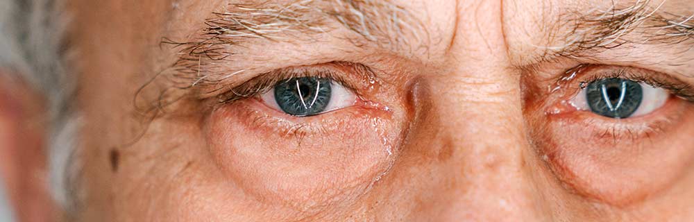 Edema maculare diabetico