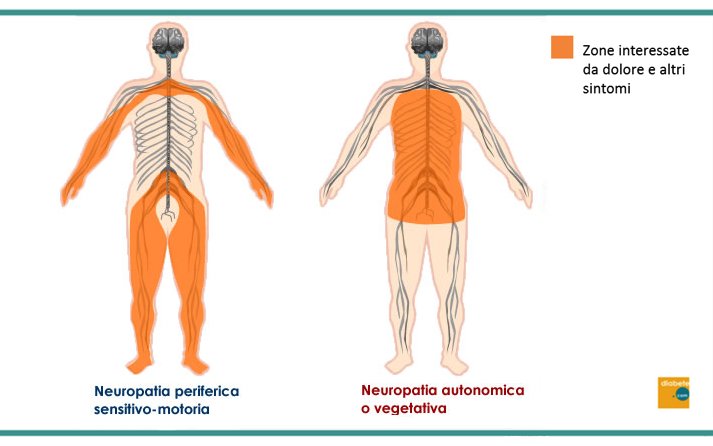 Neuropatia diabetica: tutto quello che serve sapere - ultimo position statement ADA