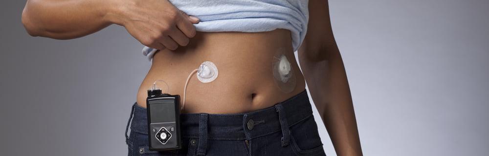 Diabete: disponibile anche in Italia il nuovo MiniMed™ Mio™ Advance