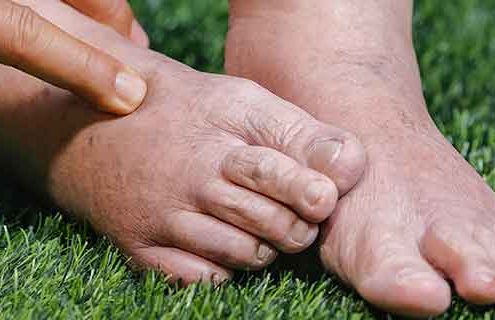 Il piede di Charcot: che cosa è importante sapere
