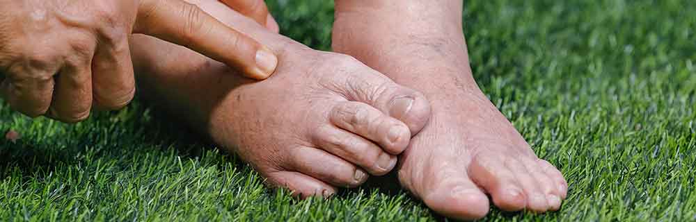 Il piede di Charcot: che cosa è importante sapere