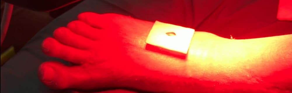 La terapia fotodinamica nel trattamento del piede diabetico - Diabete.com