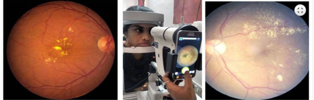 EyeArt: l’intelligenza artificiale per la cura dei nostri occhi