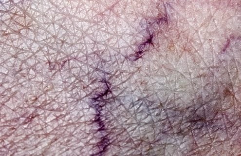 Vene varicose: nuove modalità d’intervento mininvasive