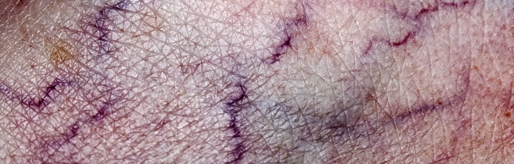 Vene varicose: nuove modalità d’intervento mininvasive