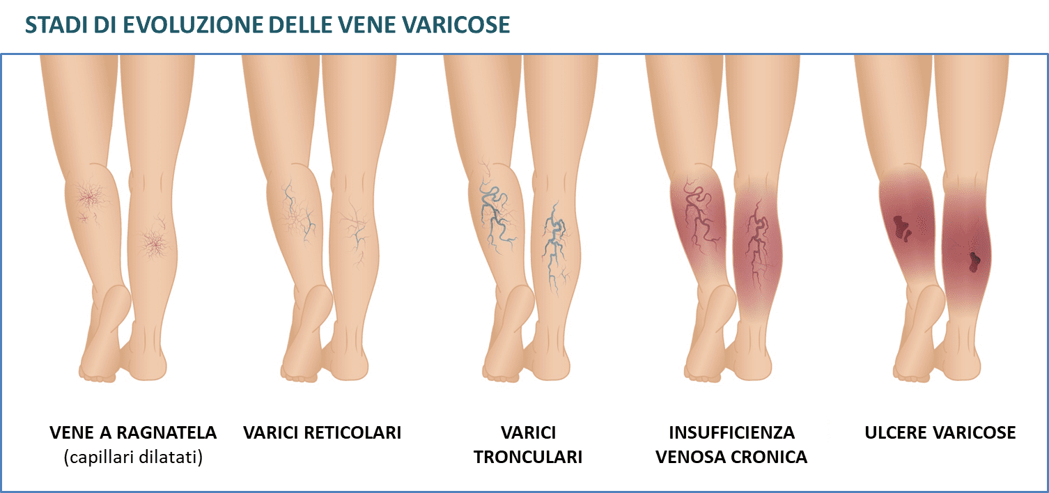Vene Varicose