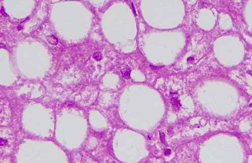 Diagnosi precoce di ‘fegato grasso’? Sarà possibile grazie a un nuovo esame del sangue