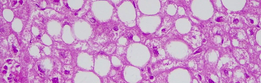Diagnosi precoce di ‘fegato grasso’? Sarà possibile grazie a un nuovo esame del sangue