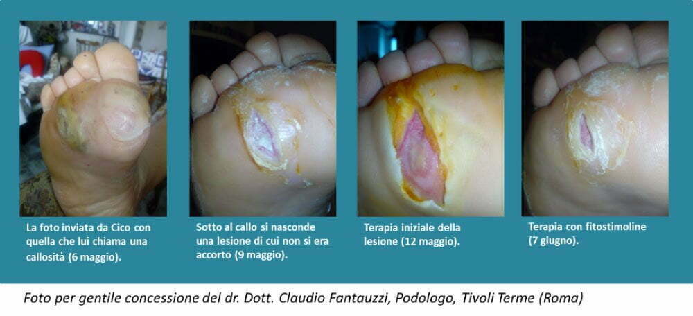 Diabete.com - Lesioni piede diabetico Diabete.com - Lesioni piede diabetico