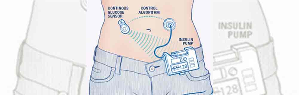Diabete.com - 6 domande sul Pancreas Artificiale