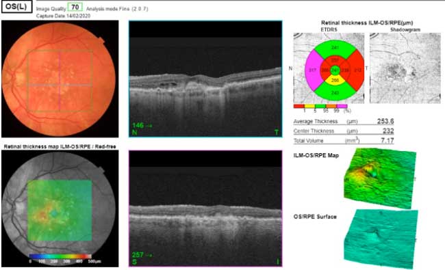 Maculopatia Diagnosi: OCT degenerazione maculare - Diabete.com Maculopatia Diagnosi: OCT degenerazione maculare - Diabete.com