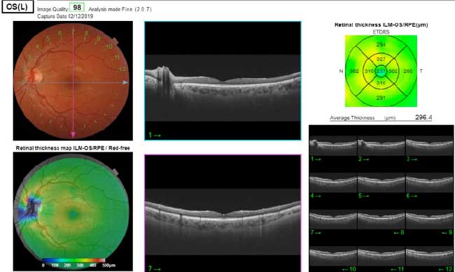 Maculopatia Diagnosi: OCT di una retina sana - Diabete.com Maculopatia Diagnosi: OCT di una retina sana - Diabete.com