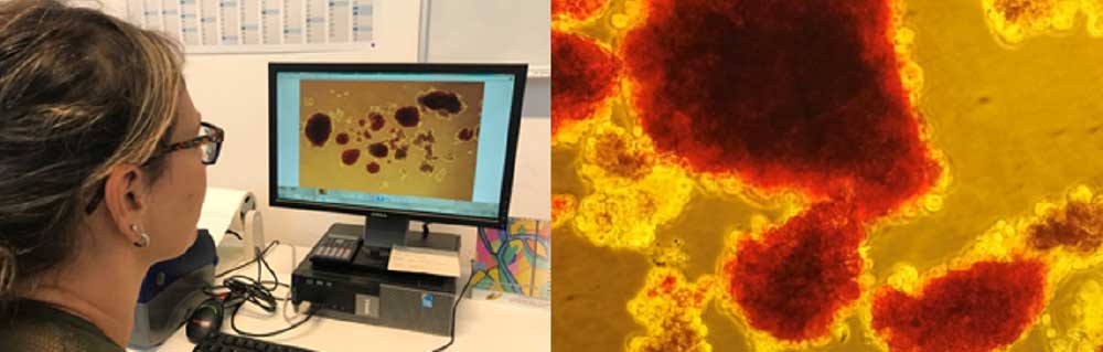 Trapianto di Isole Pancreatiche: Cura del Diabete di Tipo 1 - Diabete.com