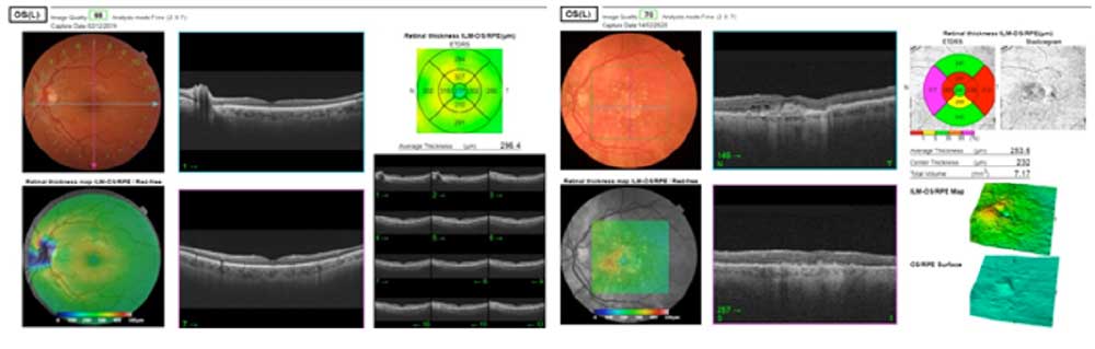 Maculopatia Diagnosi: OCT e Fluorangiografia - Diabete.com
