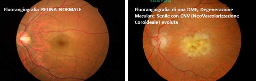 Maculopatia Diagnosi: OCT e Fluorangiografia - Diabete.com Maculopatia Diagnosi: OCT e Fluorangiografia - Diabete.com
