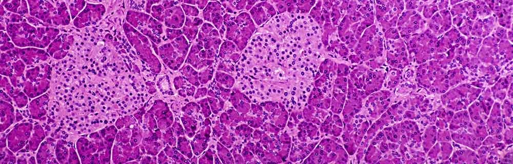 Ricerca sul diabete tipo 1: scoperto un meccanismo che causa la morte delle cellule beta del pancreas e come disattivarlo