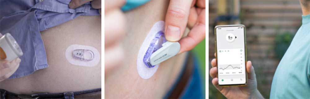 Sistema Cgm Dexcom One in Italia: firmato accordo di distribuzione
