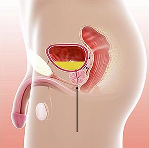 Prostata